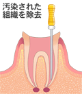 根管治療(歯の神経の治療)とは