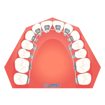 舌側矯正（インコグニート