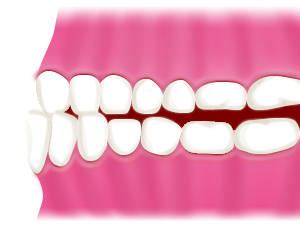 対咬合（はんたいこうごう）