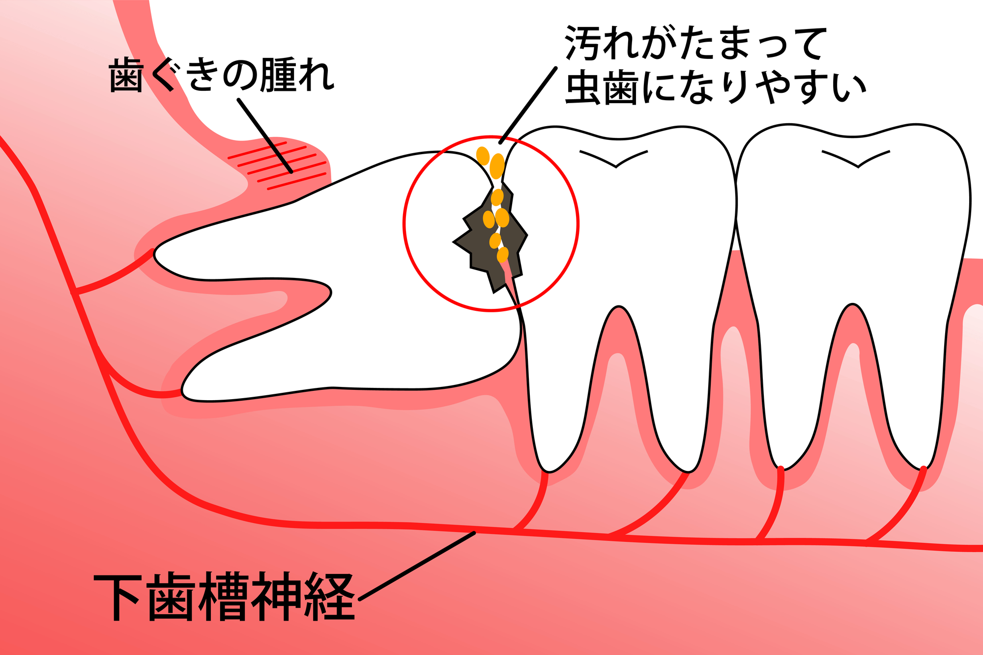 親知らずを抜いた方が良い場合