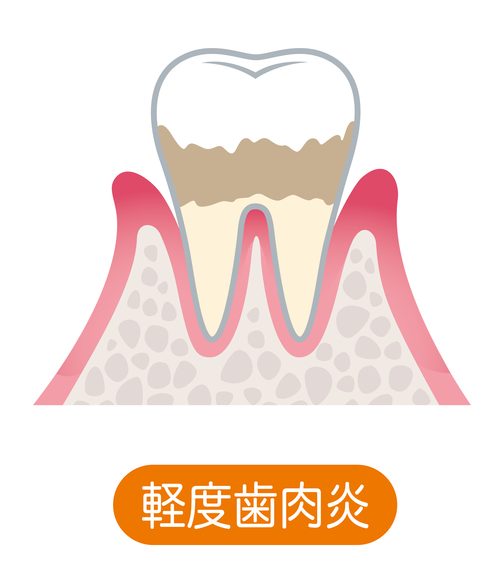 軽度歯周炎